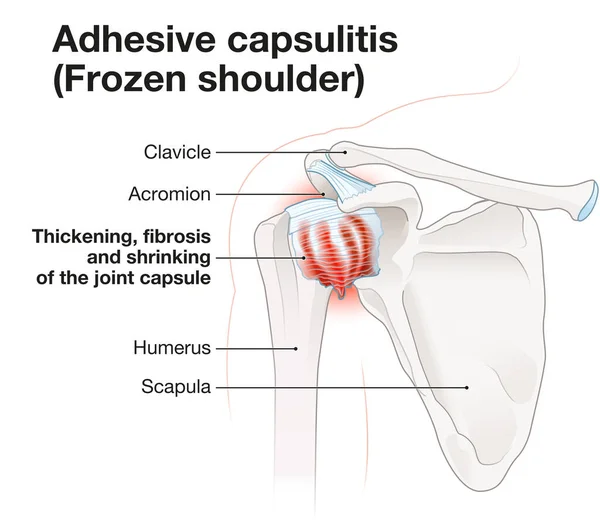 Gefrorene Schulter Adhäsive Kapsulitis Beschriftete Illustration — Stockfoto