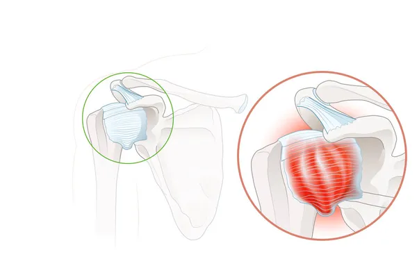 Spalla Congelata Chirurgia Della Capsulite Adesiva Illustrazione Etichettata — Foto Stock