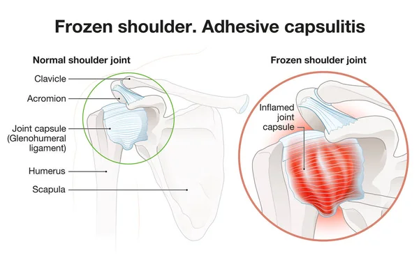 Frozen Shoulder Adhesive Capsulitis Surgery Labeled Illustration — Stock Photo, Image