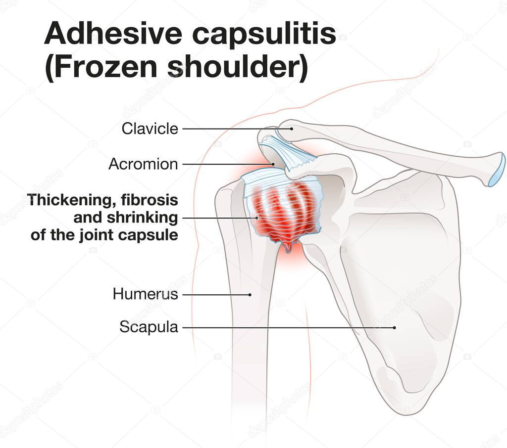 Frozen shoulder. Adhesive capsulitis. Labeled Illustration