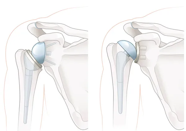 Ilustração Mostrando Artroplastia Reversa Ombro Artroplastia Total Ombro — Fotografia de Stock
