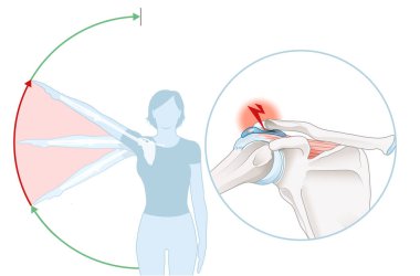 Illustration showing shoulder impingement syndrome and painful arc clipart