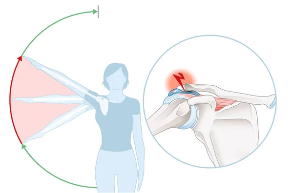 Illustration Zeigt Schulterimpingement Syndrom Und Schmerzhaften Lichtbogen — Stockfoto