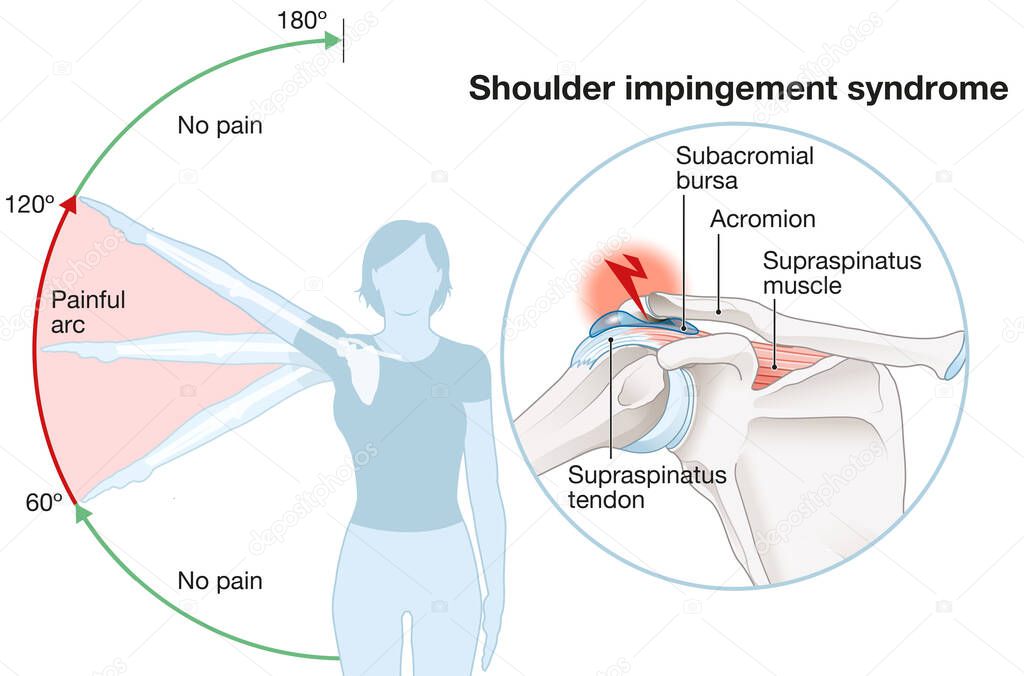 Illustration showing shoulder impingement syndrome and painful arc