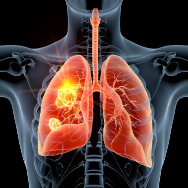 Highlighted carcinoma in right lung, 3D illustration clipart