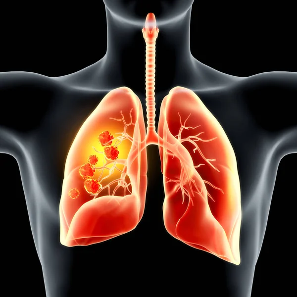 Carcinoma Resaltado Pulmón Derecho Ilustración —  Fotos de Stock