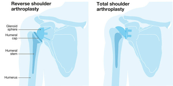 Illustration showing reverse shoulder arthroplasty and total shoulder arthroplasty