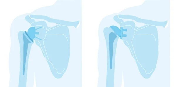 Abbildung Zeigt Reverse Shoulder Arthroplastik Und Gesamt Schulterarthroplastik — Stockfoto