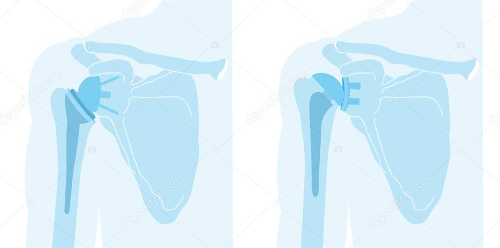 Illustration showing reverse shoulder arthroplasty and total shoulder arthroplasty