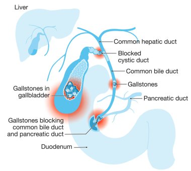 Gallstone disease. gallstones blocking bile duct and pancreatic duct. Labeled Illustration clipart