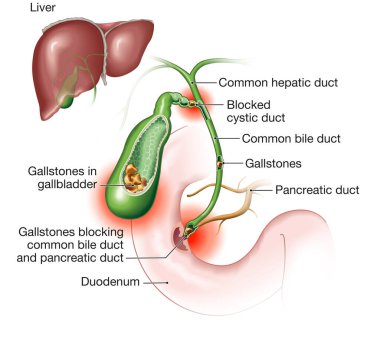 Gallstone disease. gallstones blocking bile duct and pancreatic duct. Labeled Illustration clipart