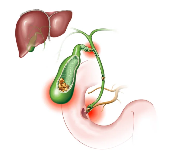 Doença Gallstone Cálculos Biliares Bloqueando Ducto Biliar Ducto Pancreático Ilustração — Fotografia de Stock