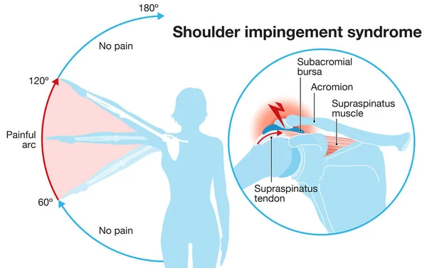 Illustration Montrant Syndrome Impactement Des Épaules Arc Douloureux — Photo