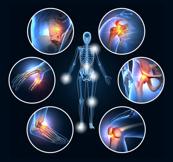 Set Six Painful Joints Medical Illustration — Stock Photo, Image