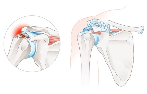 Ilustración Que Muestra Tendinitis Calcifica Hombro —  Fotos de Stock