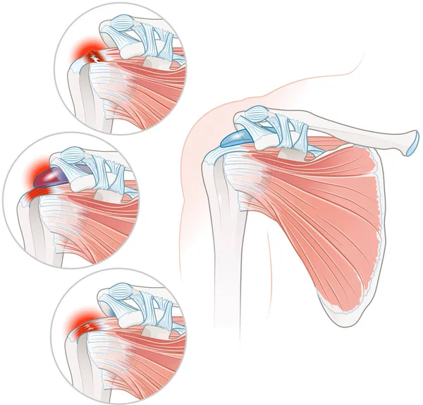 Illustration Showing Shoulder Rotator Cuff Disease Illustration — Foto de Stock