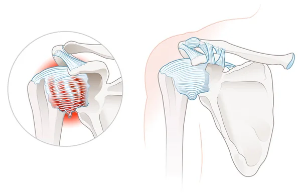 Illustration Showing Frozen Shoulder Adhesive Capsulitis Illustration Labeled — Fotografia de Stock