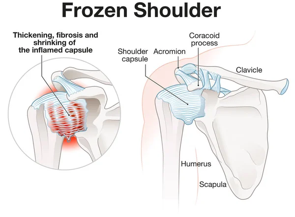 Illustration Showing Frozen Shoulder Adhesive Capsulitis Illustration Labeled — Stock Photo, Image