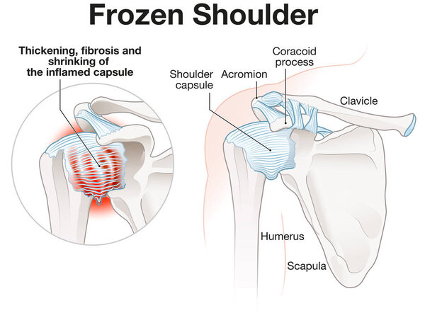 Illustration showing frozen shoulder adhesive capsulitis illustration. Labeled