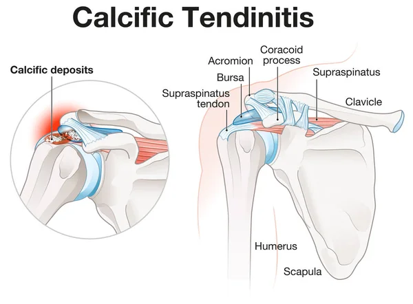 Illustration Showing Calcific Cendinitis Shoulder — Stock fotografie