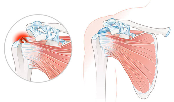 Illustration showing rotator cuff tear shoulder 