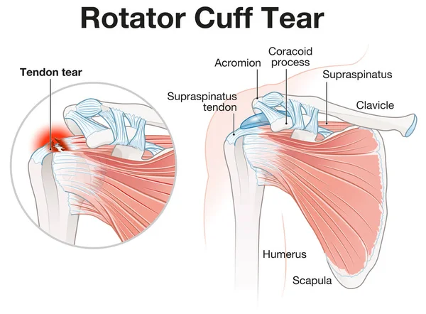 Illustration Showing Rotator Cuff Tear Shoulder Illustration — Foto de Stock