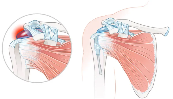 Illustration Showing Rotator Cuff Bursitis — Foto de Stock