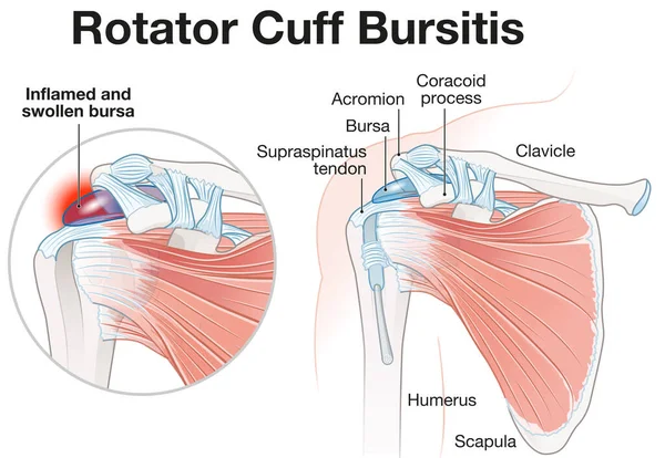 Ilustración Que Muestra Bursitis Del Manguito Rotador — Foto de Stock