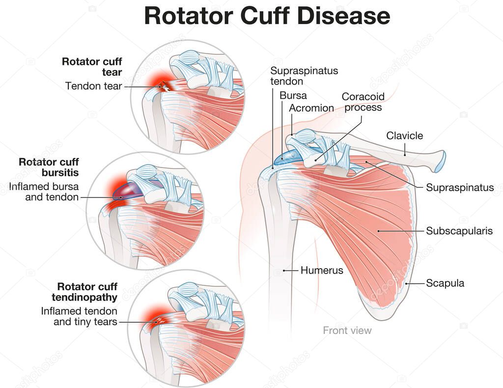 Illustration showing shoulder rotator cuff disease illustration.