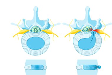 Illustration showing normal disc and herniated disc. Normal disc. Bulge. Protrusion. Extrusion. Sequestration. Labeled illustration clipart
