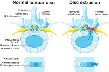 Illustration showing normal disc and herniated disc. Normal disc. Bulge. Protrusion. Extrusion. Sequestration. Labeled illustration clipart
