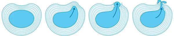 Illustration showing herniated disc schema. Normal disc. Bulge. Protrusion. Extrusion. Sequestration. Labeled illustration