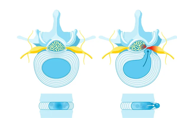 Ilustración Disco Normal Hernia Discal Disco Normal Protuberancia Protrusión Extrusión —  Fotos de Stock