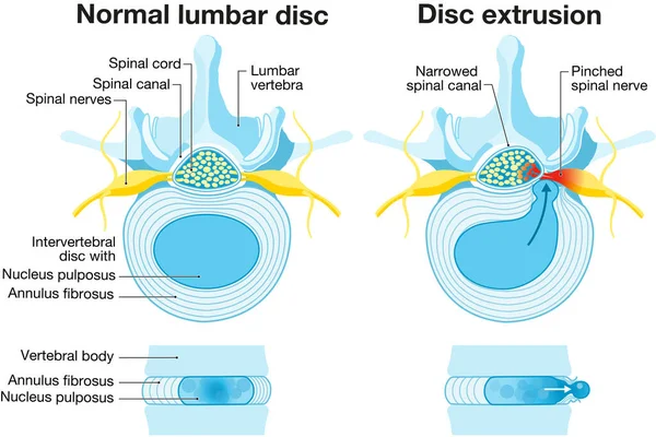 Görüntü normal disk ve fıtık diski gösteriyor. Normal disk. Şişkinlik. Çıkıntı. Ekstraksiyon. Sezaryen. Etiketli illüstrasyon