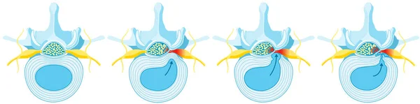 Illustration Showing Herniated Disc Schema Normal Disc Bulge Protrusion Extrusion — Stock Photo, Image