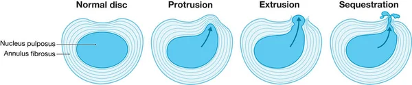 Illustration showing herniated disc schema. Normal disc. Bulge. Protrusion. Extrusion. Sequestration. Labeled illustration