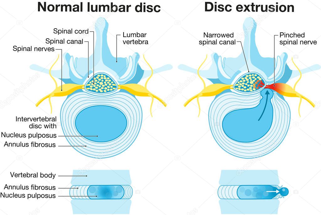 Illustration showing normal disc and herniated disc. Normal disc. Bulge. Protrusion. Extrusion. Sequestration. Labeled illustration