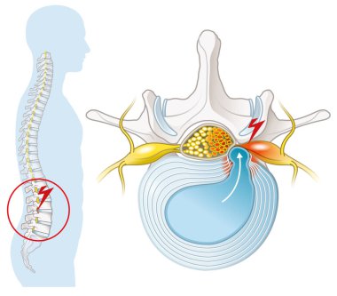 Illustration showing lumbar vertebra with intervertebral disc and herniated nucleus pulposus clipart