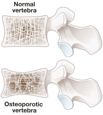 Osteoporoz, normal omurga ve osteoporotik omurları gösteren ilüzyon. Etiketli illüstrasyon