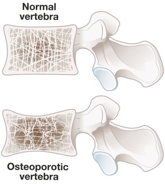 Illustration showing osteoporosis, normal vertebra and osteoporotic vertebra. Labeled illustration clipart