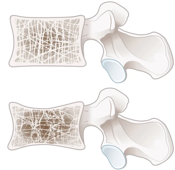 Osteoporoz Normal Omurga Osteoporotik Omurları Gösteren Ilüzyon Etiketli Illüstrasyon — Stok fotoğraf