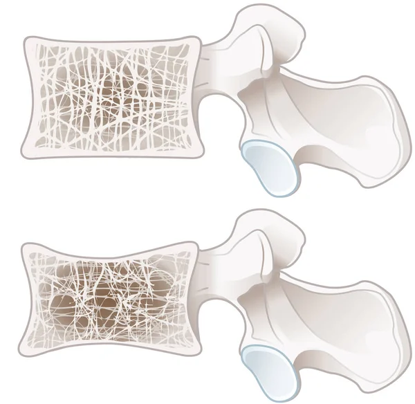 Illustration Som Visar Osteoporos Normal Ryggkota Och Osteoporos Märkt Illustration — Stockfoto