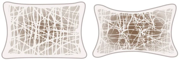 Illustration showing osteoporosis, normal vertebra and osteoporotic vertebra. Labeled illustration