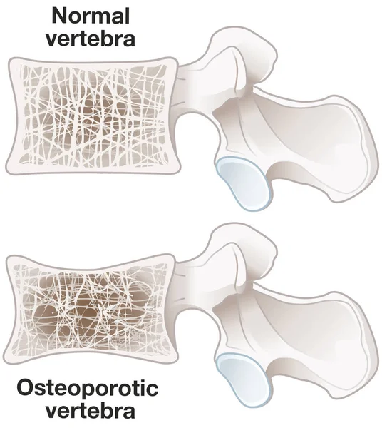 Ilustracja Wykazująca Osteoporozę Normalne Kręgi Kręgi Osteoporozyczne Ilustracja Oznaczona Etykietą — Zdjęcie stockowe