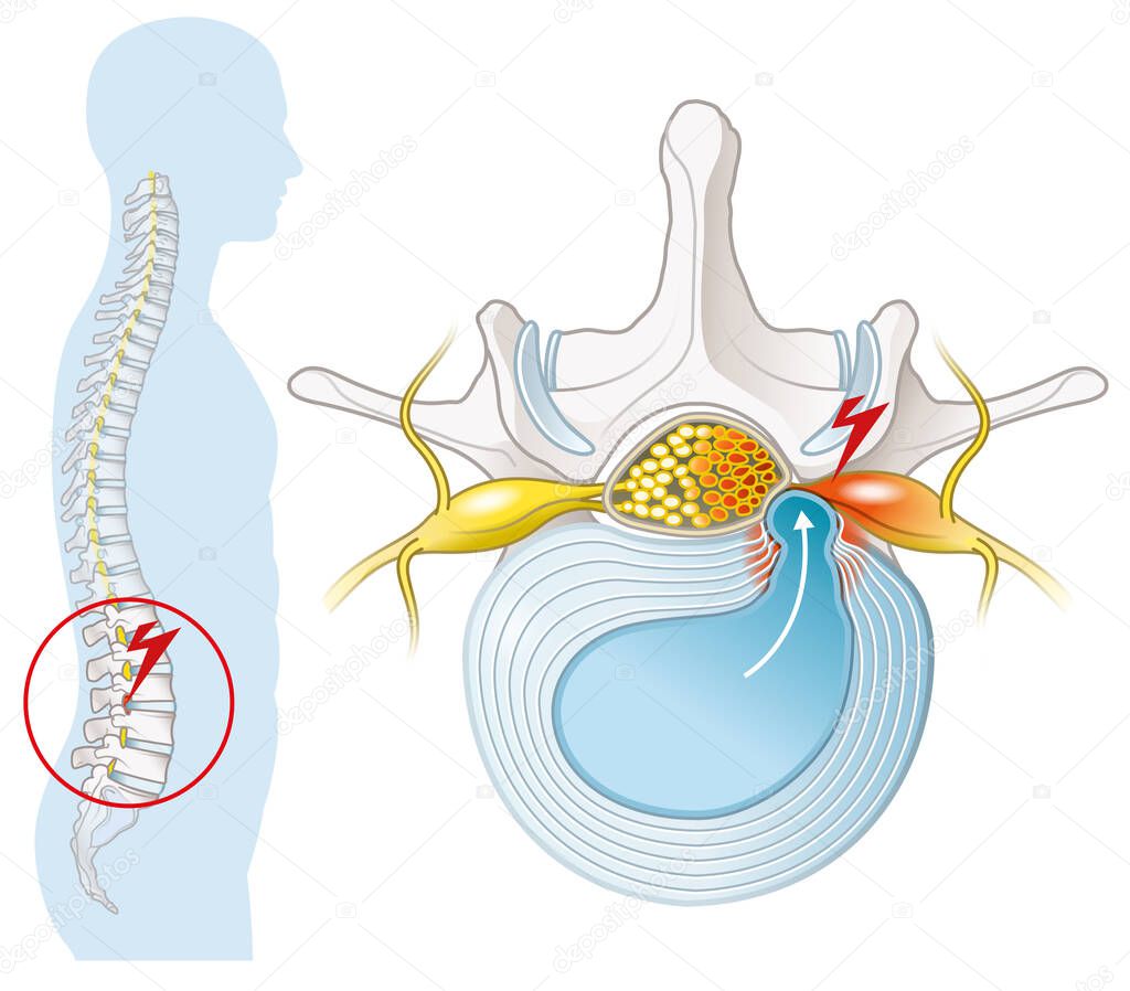 Illustration showing lumbar vertebra with intervertebral disc and herniated nucleus pulposus