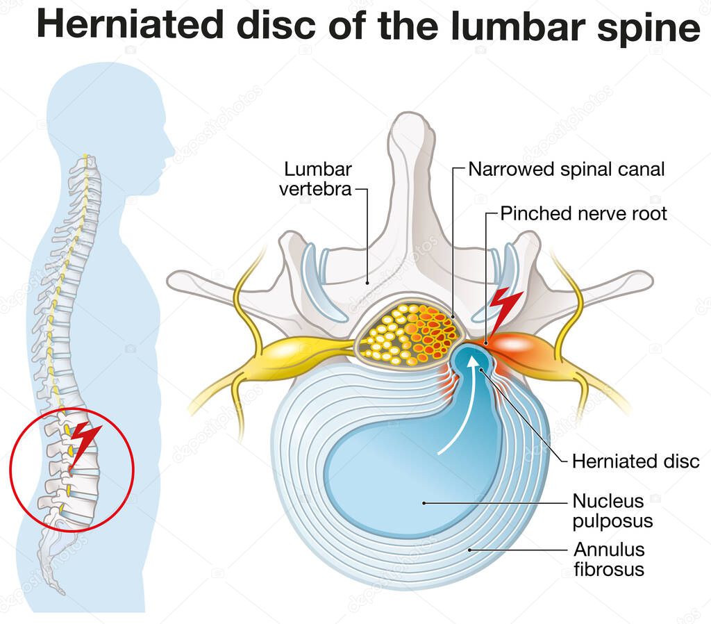 Illustration showing lumbar vertebra with intervertebral disc and herniated nucleus pulposus
