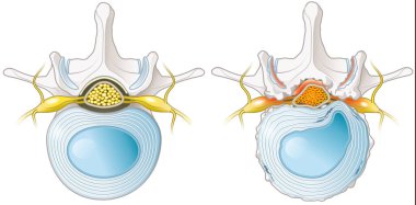 Illustration showing spinal canal stenosis lumbar vertebra with intervertebral disc and herniated nucleus pulposus