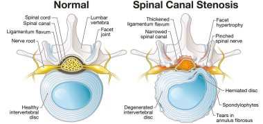 Illustration showing spinal canal stenosis lumbar vertebra with intervertebral disc and herniated nucleus pulposus
