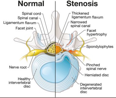 Illustration showing spinal canal stenosis lumbar vertebra with intervertebral disc and herniated nucleus pulposus