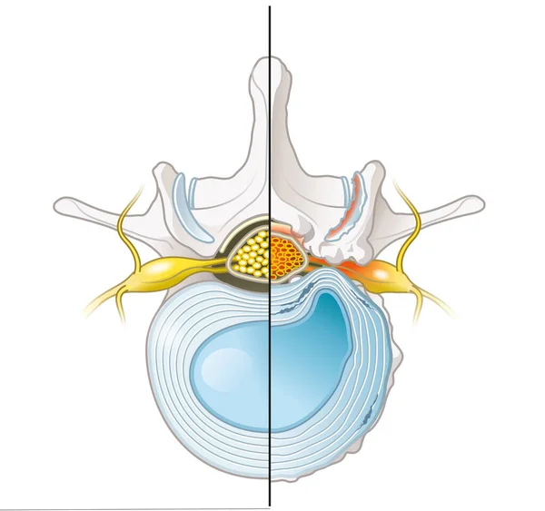 Illustration Showing Spinal Canal Stenosis Lumbar Vertebra Intervertebral Disc Herniated — Zdjęcie stockowe